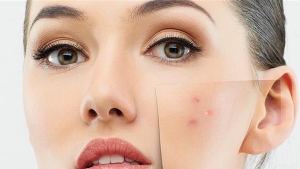 علاج حب الشباب بمكونات طبيعية من مطبخك  .. بالميه والملح