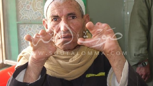  بالصور: «مستعمرات الجذام».. الموت على صخرة الإهمال