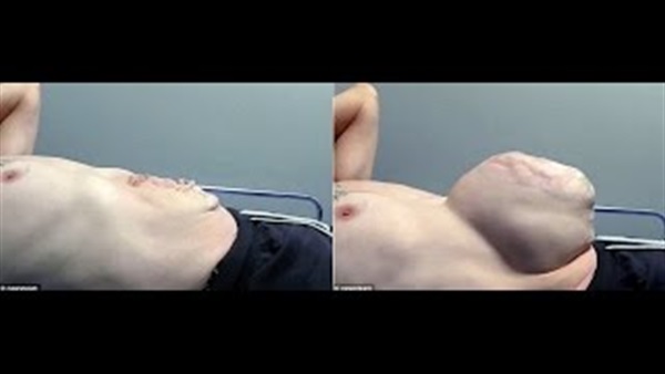 بالفيديو.. مسن يتخلص من فتق بحجم «حمل في توأم»